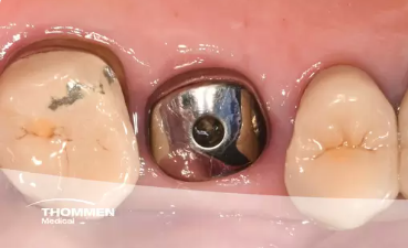 Immediate NEVO Implant Placement