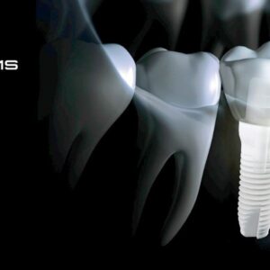 L'implant en Zircone : une alternative au titane