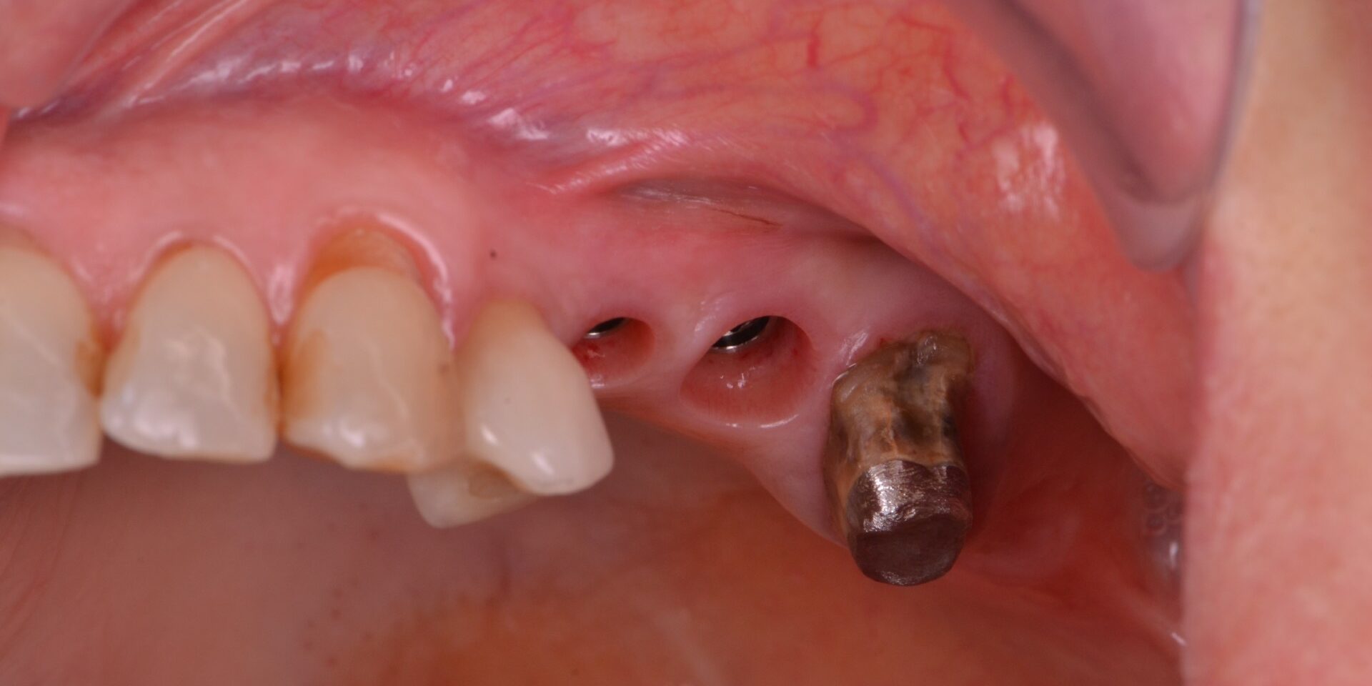 Formation en implantologie dentaire : de la planification à la pose des premiers implants